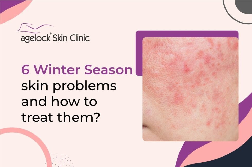 6 Winter season skin problems and how to treat them