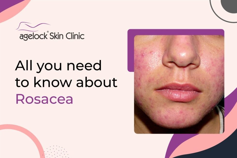 All you need to know about Rosacea: Symptoms, causes, and treatment