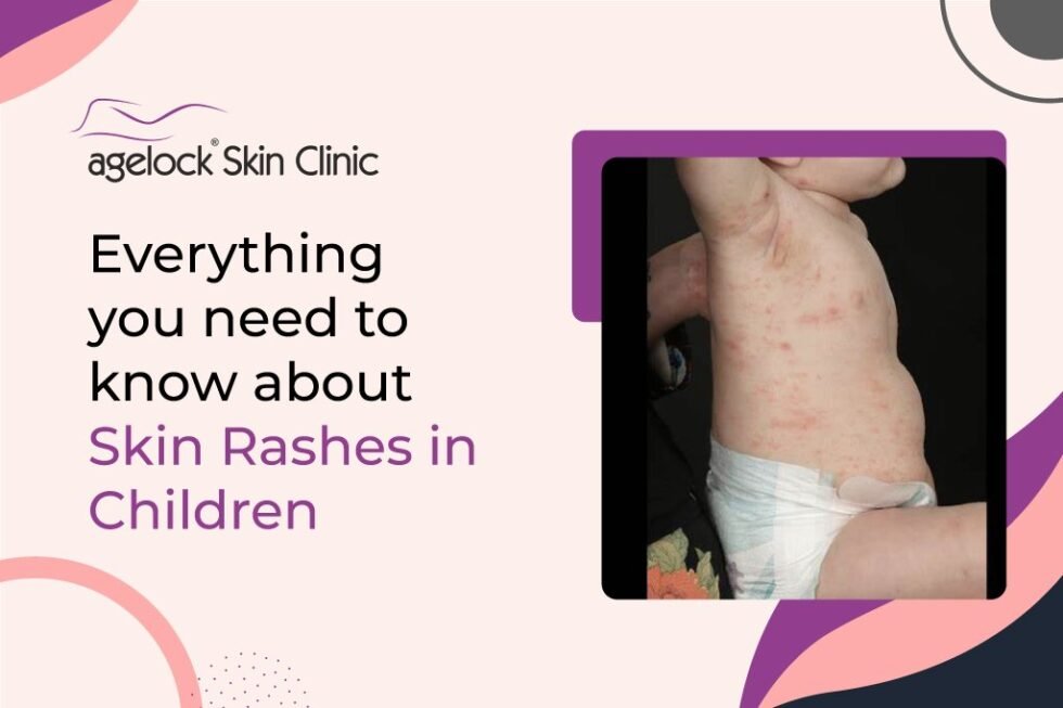 Everything you need to know about skin rashes in children – Causes, prevention, and treatment