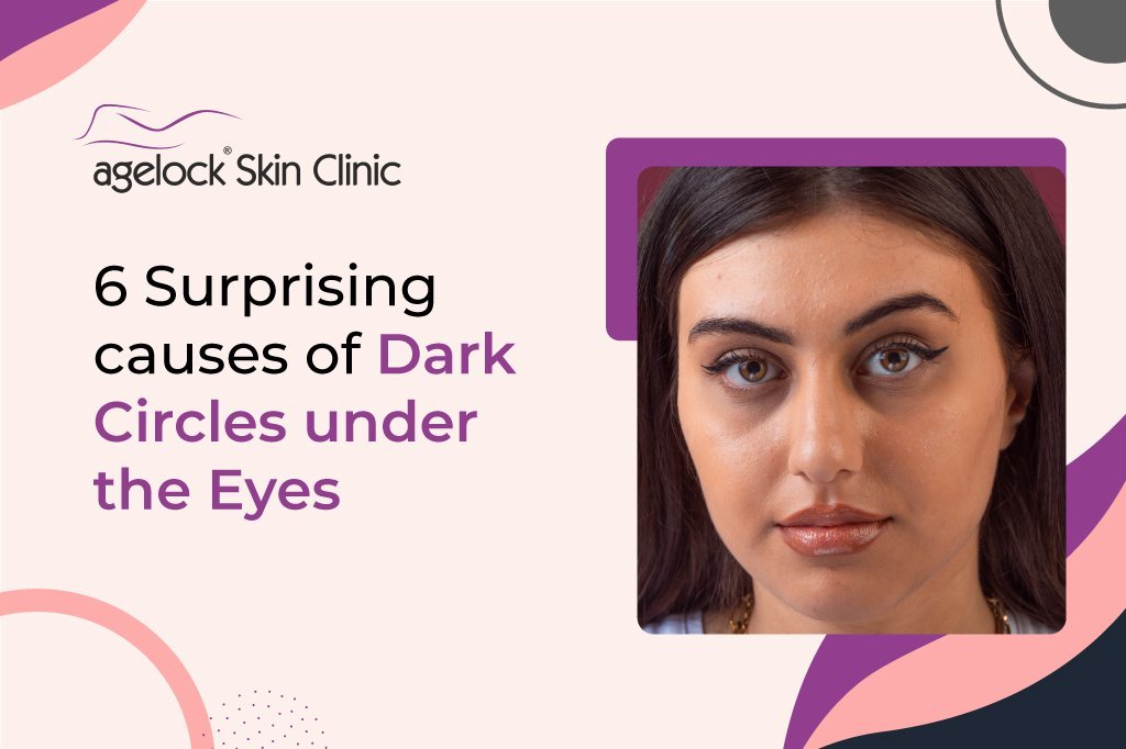 6 surprising causes of dark circles under the eyes 6 surprising causes of dark circles under the eyes