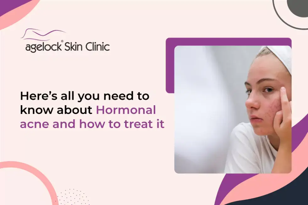 Here’s all you need to know about Hormonal acne and how to treat it