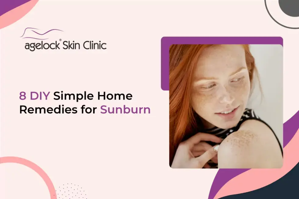 8 DIY Simple Home Remedies for Sunburn