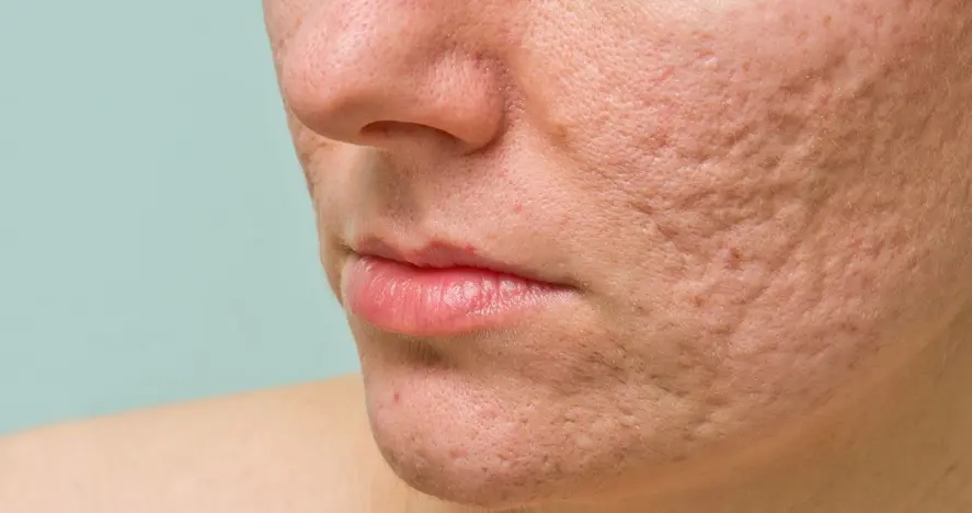 acne-scare Acne Scars Treatment in Chandigarh