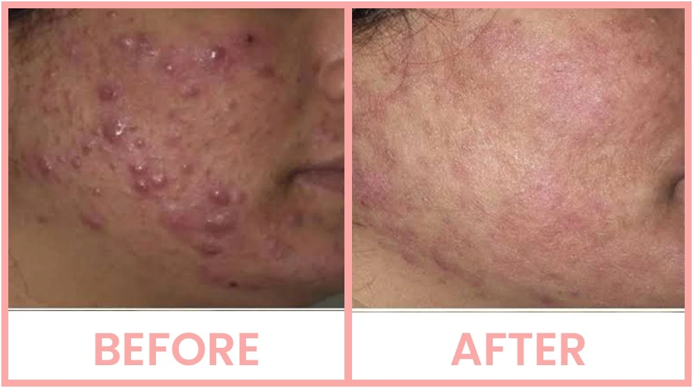 carbon-laser-peel-before Carbon Laser Peel For Acne Treatment in Chandigarh