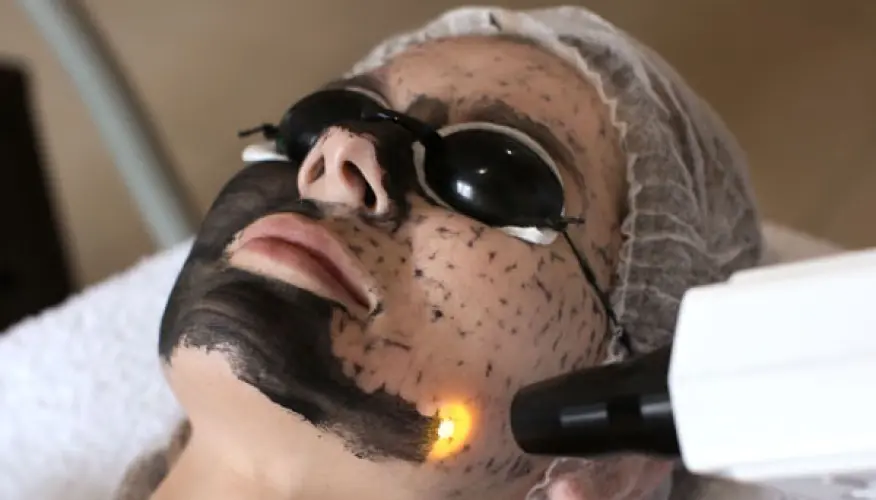 carbonlaserfacial Benifits
