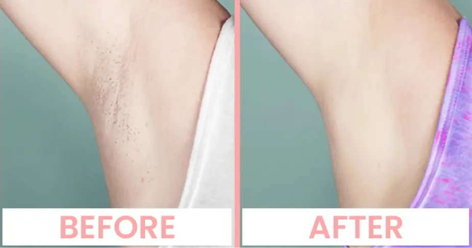 Laser Hair Removal Treatment in Chandigarh