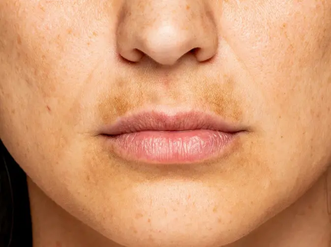 Types of face laser treatment