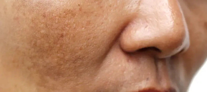 Benefits of face laser treatment