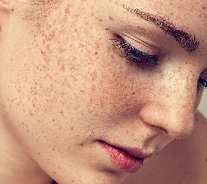 PicoSure face laser treatment at Agelock