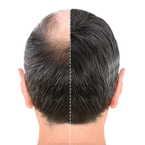 hair transplant
