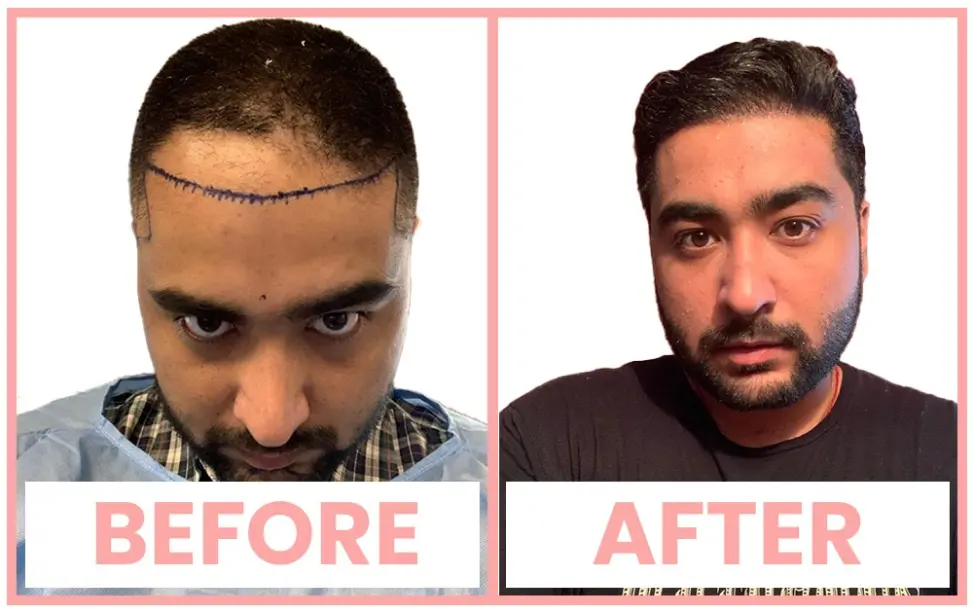 Hair Transplant in Chandigarh