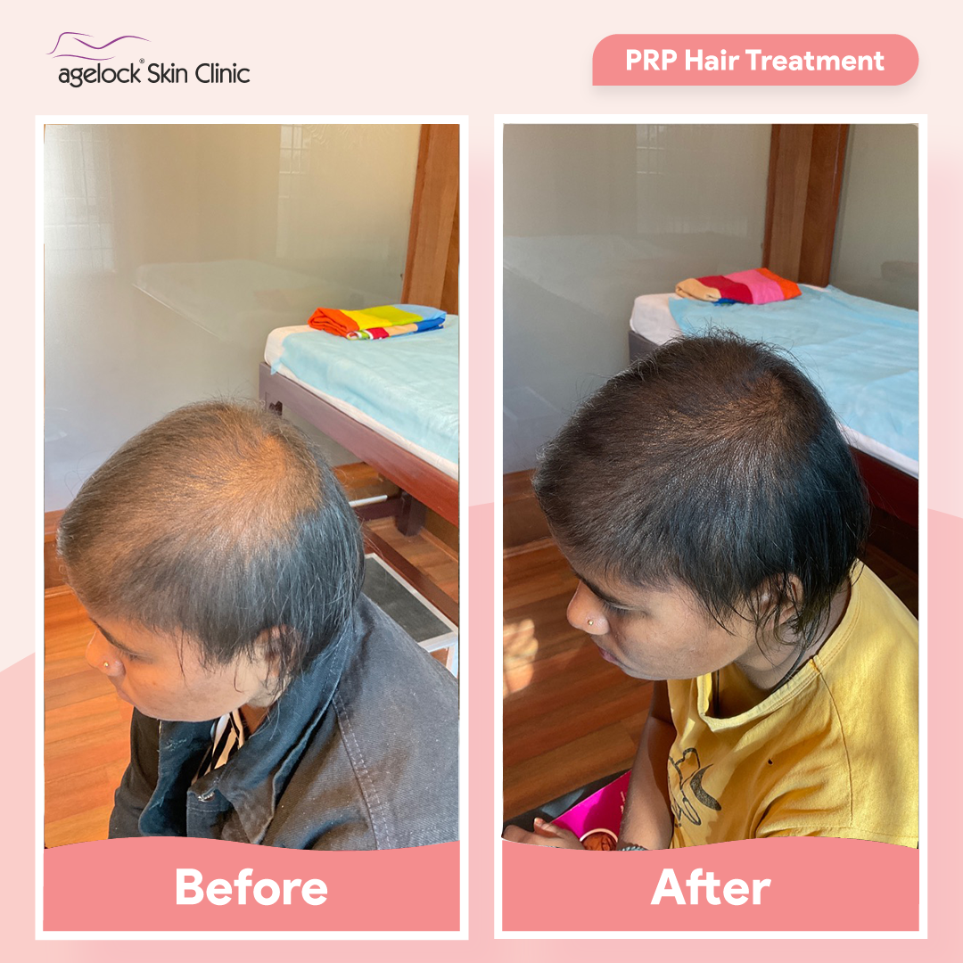 PRP hair treatment before and after results