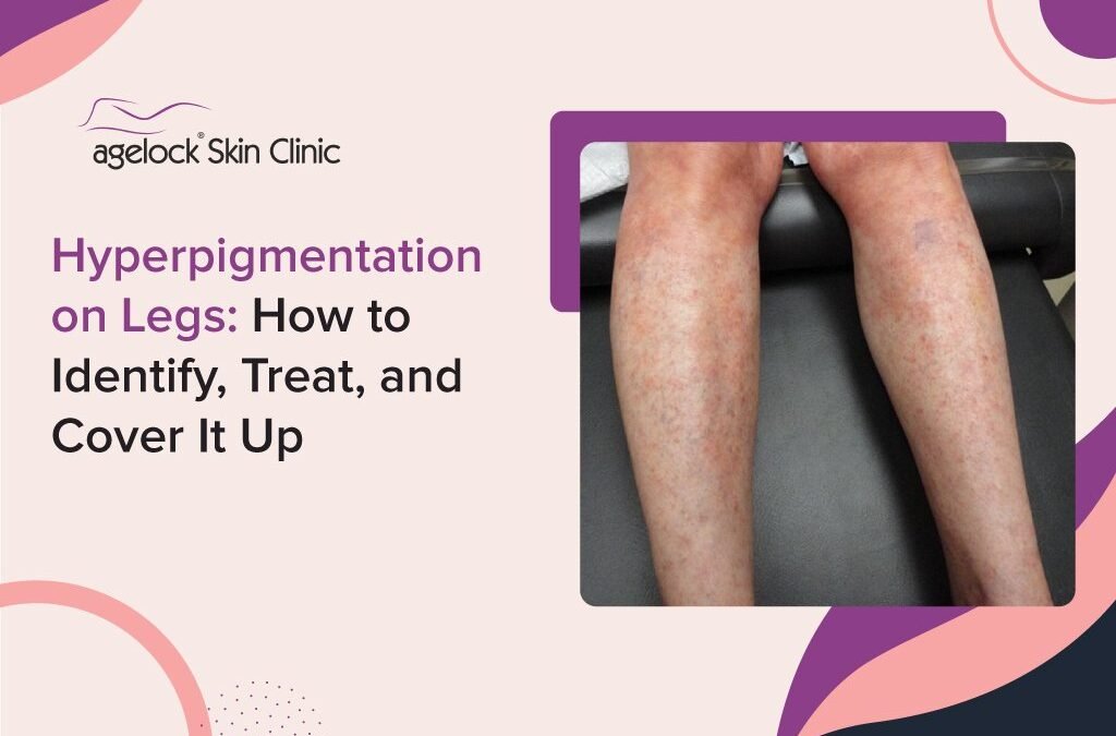 Hyperpigmentation on Legs: How to Identify, Treat, and Cover It Up