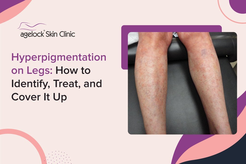 Hyperpigmentation on Legs: How to Identify, Treat, and Cover It Up Hyperpigmentation on Legs: How to Identify, Treat, and Cover It Up