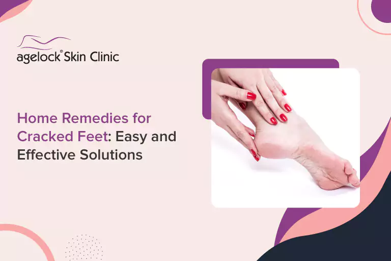 Home Remedies for Cracked Feet: Easy and Effective Solutions