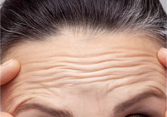 Anti Wrinkle Injection Treatment In Chandigarh