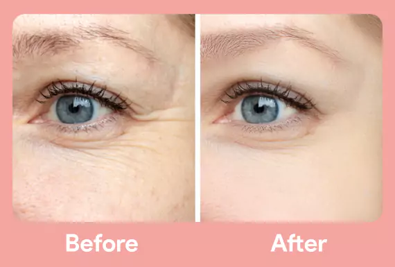 Anti Wrinkle Injection Treatment In Chandigarh