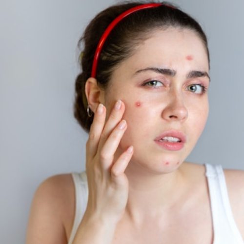 Acne Removal treatment at Agelock