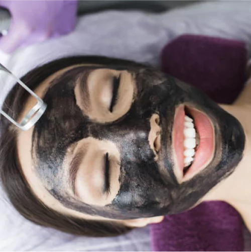 Carbon Peel for Pigmentation