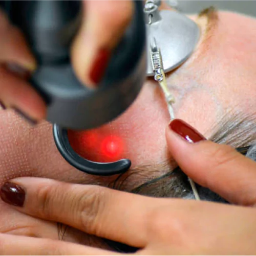 CO2 Laser Treatment For Acne Scars