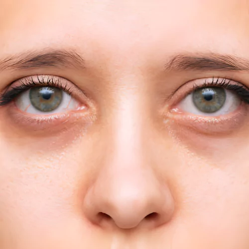 Dark Circles
