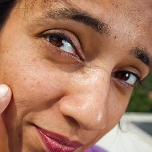 Dark Spot Removal Treatment