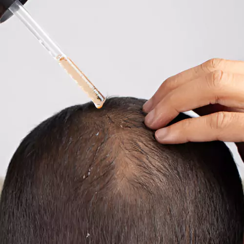 Hair Loss Treatment