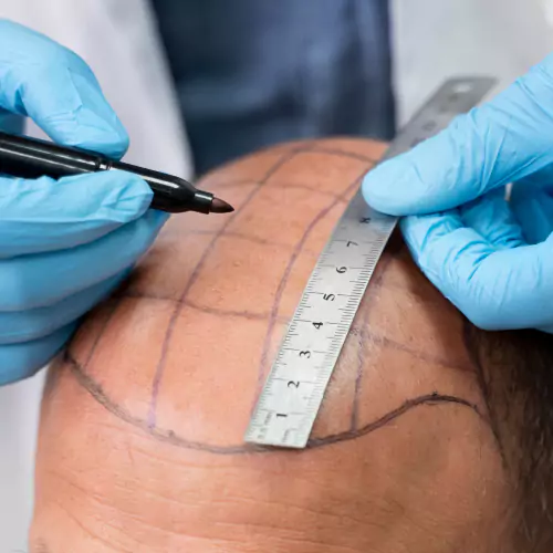 Hair Transplant Surgery