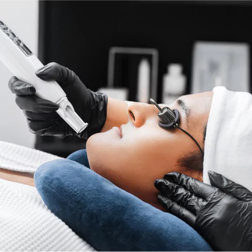 Acne Removal treatment at Agelock