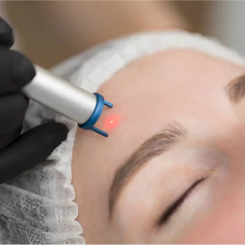 Laser Treatment for Pimple Removal