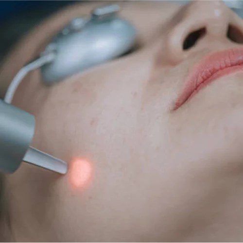 Laser Treatment for Scar Removal