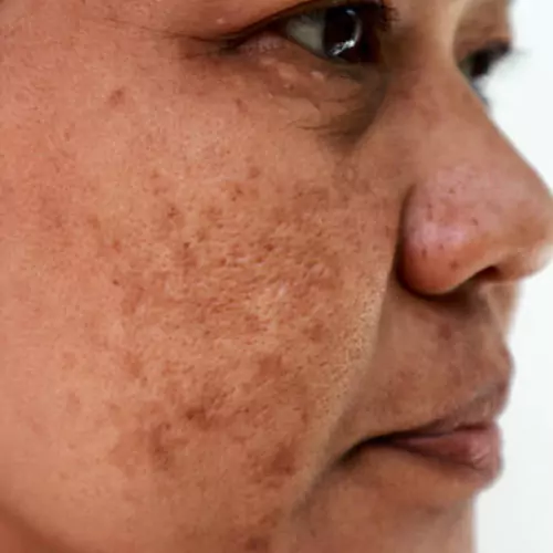 Melasma Treatment
