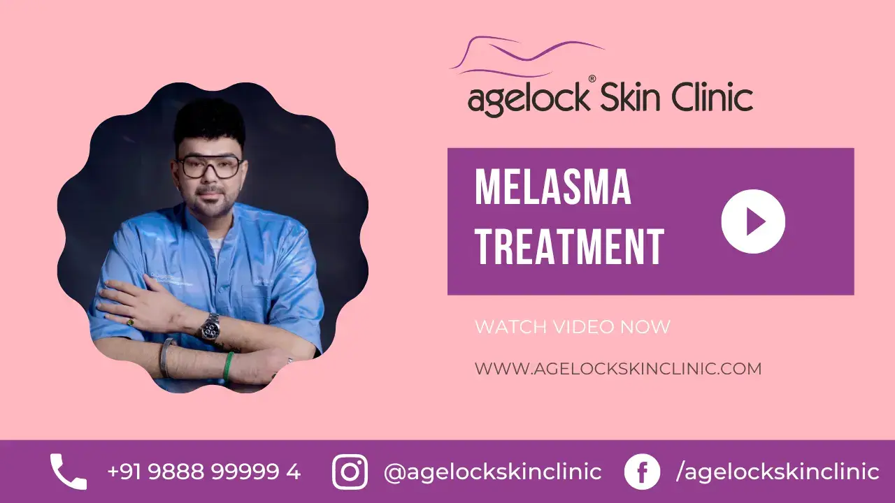 melasma Treatment Videos