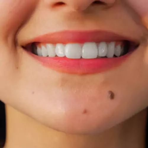 Mole Removal treatment at Agelock