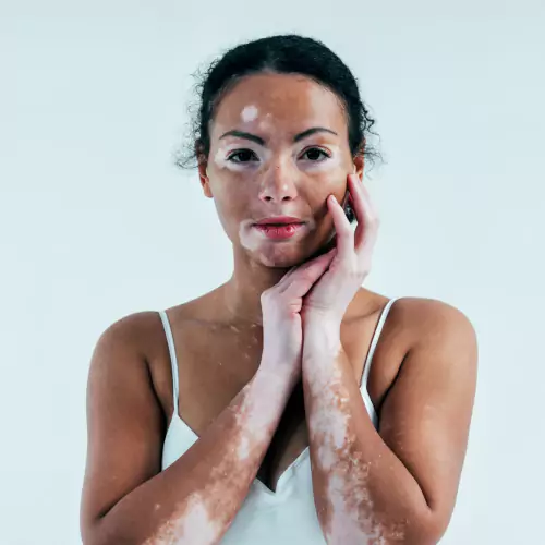 Vitiligo Treatment