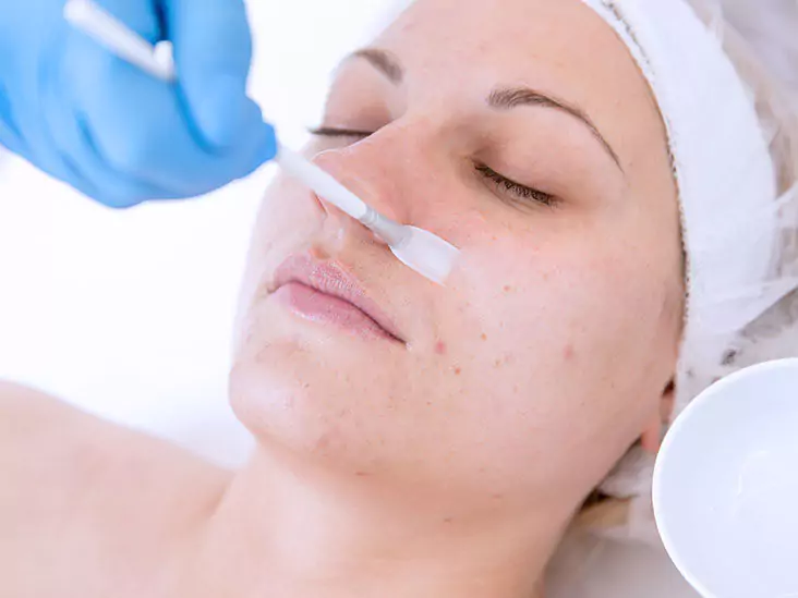 Chemical Peel Treatment in Chandigarh