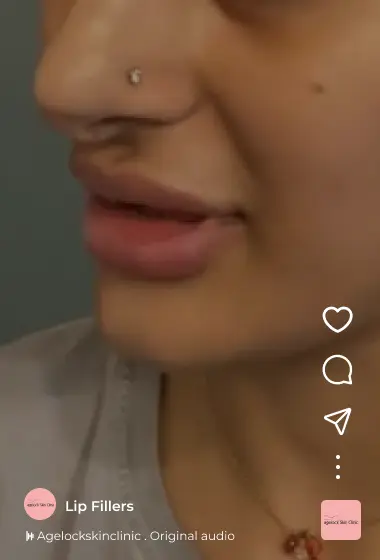 lip-filler-insta Instagram Reels