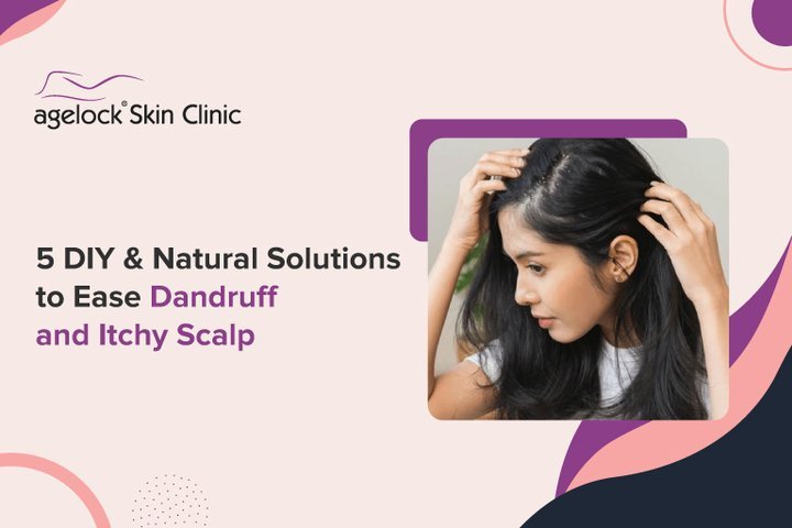 5 DIY & Natural Solutions to Ease Dandruff and Itchy Scalp