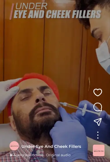 under-eye-cheek-insta Instagram Reels