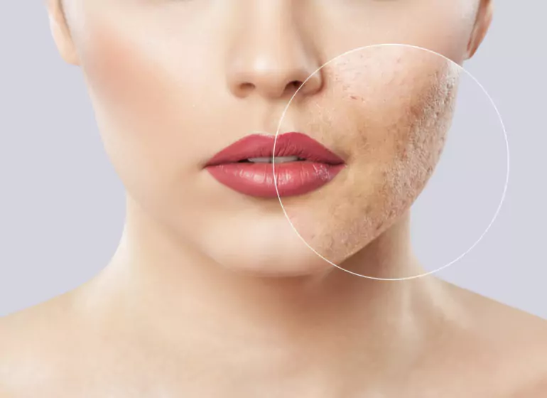 Acne Check Peel in Chandigarh