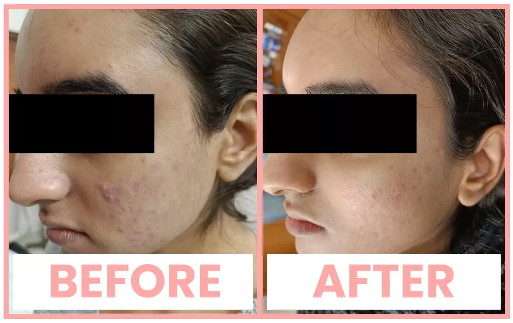 Acne Check Peel in Chandigarh
