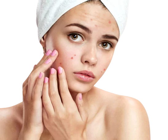 Acne Treatment in Chandigarh