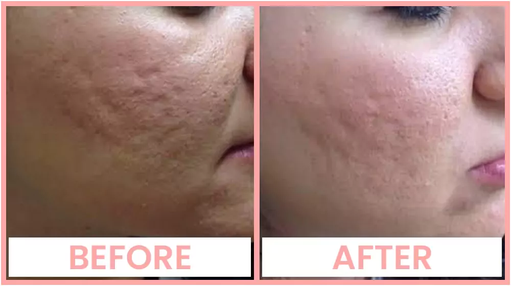 Derma Roller For Acne Scar Treatment in Chandigarh