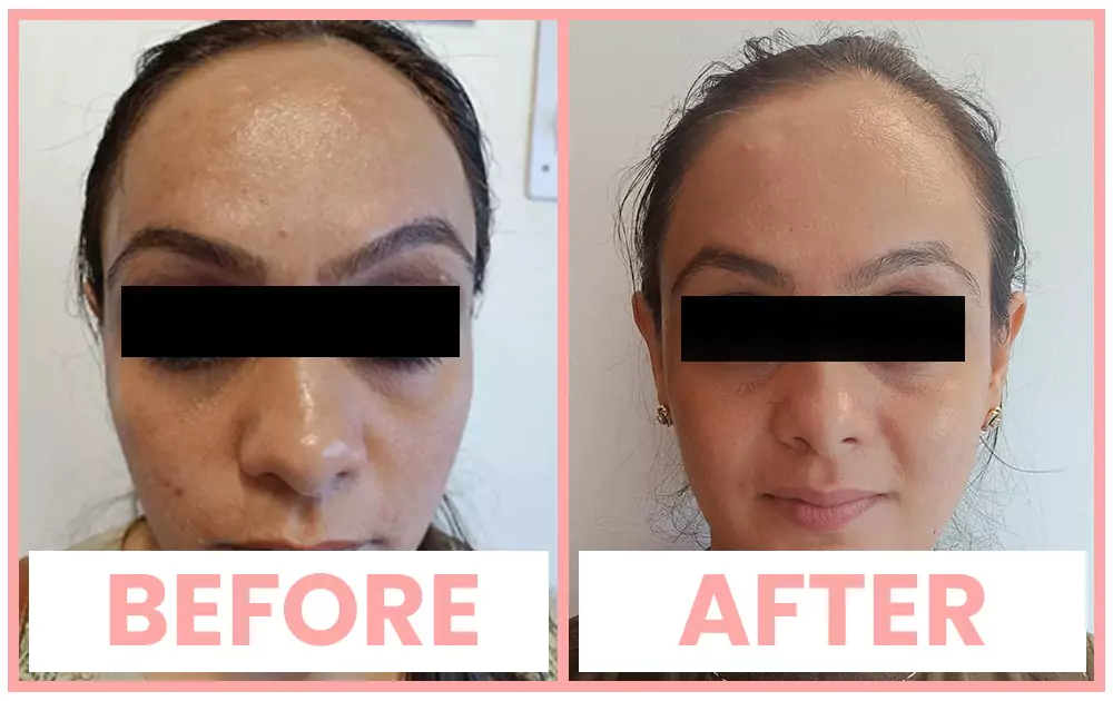 Vivace acne scar treatment before and after