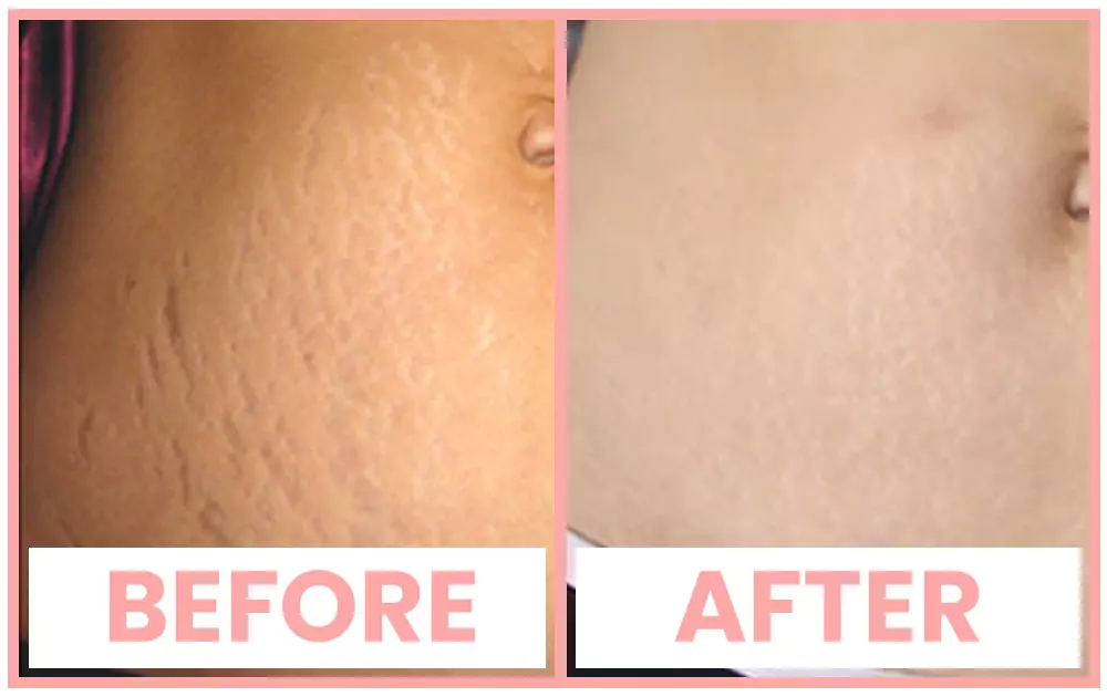 Derma Roller For Stretch Mark Removal In Chandigarh