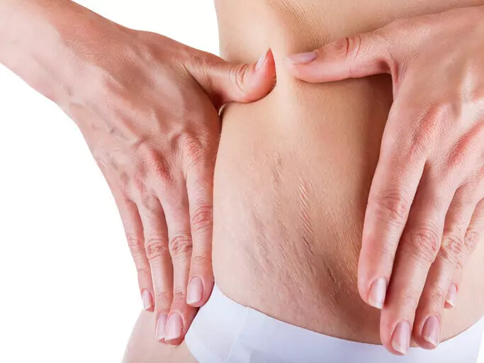Derma Roller For Stretch Mark Removal In Chandigarh