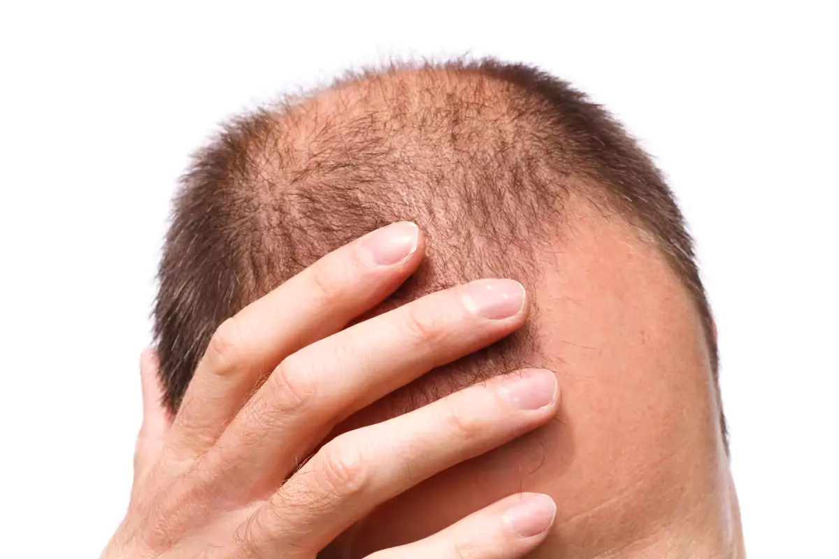 Stem cell hair loss treatment candidates