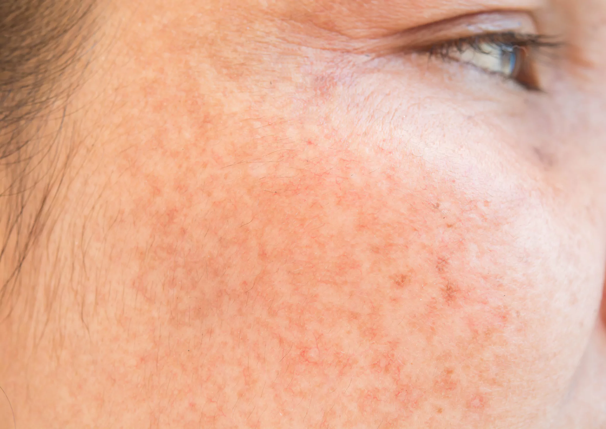 agelock-hyperpigmentation-meline-close-up Mesotherapy micro-injection for hyperpigmentation at Agelock