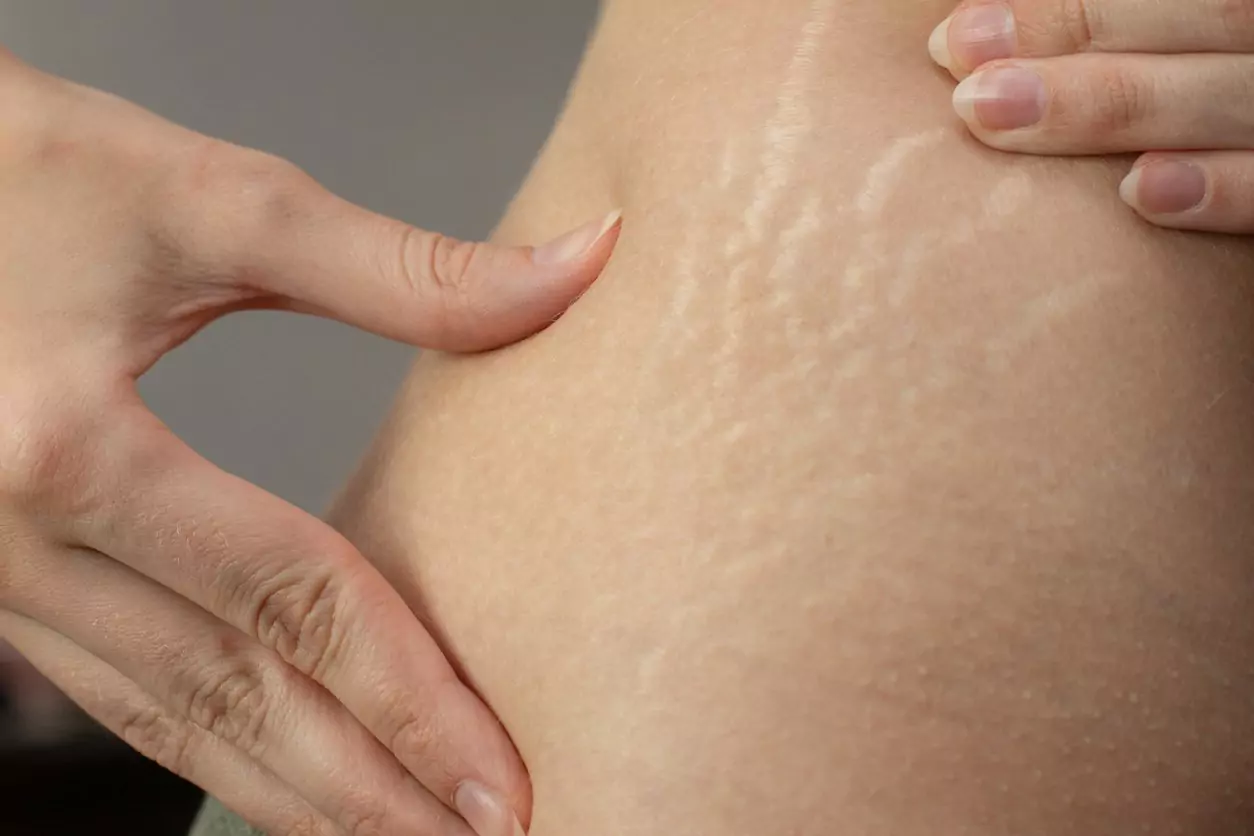 MNRF stretch mark treatment procedure at Agelock