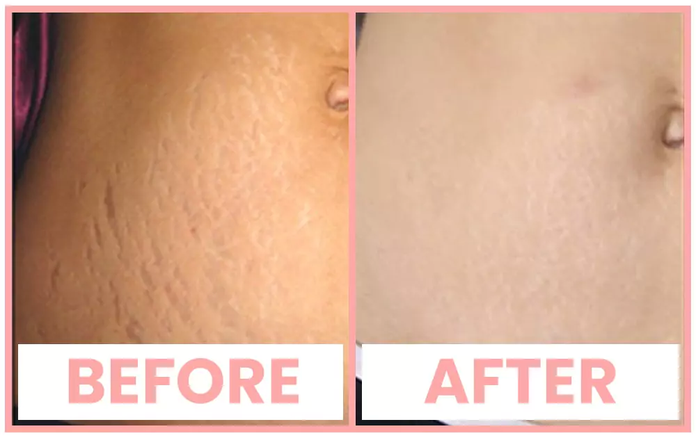 PRP stretch mark treatment before and after